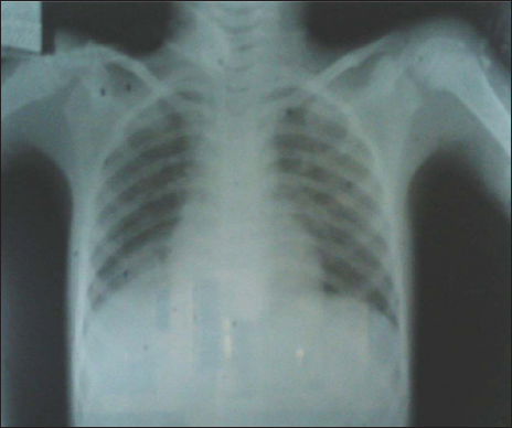 Normal chest X-ray after foreign body removal.